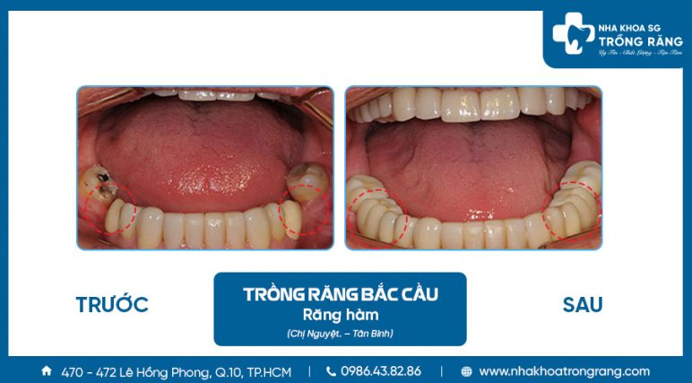 Trồng răng hàm bằng bắt cầu răng sứ Trồng răng hàm bằng bắt cầu răng sứ
