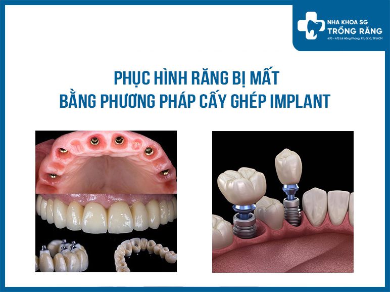 Trồng răng vĩnh viễn bằng implant tại nha khoa sài gòn Trồng răng vĩnh viễn bằng implant tại nha khoa sài gòn
