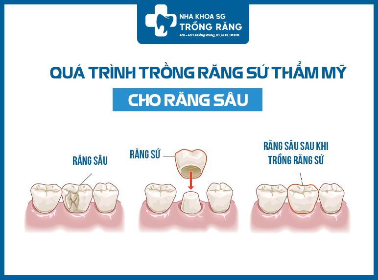 quá trình trồng răng sứ thẩm mỹ cho răng sâu