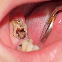 răng sâu mô phỏng