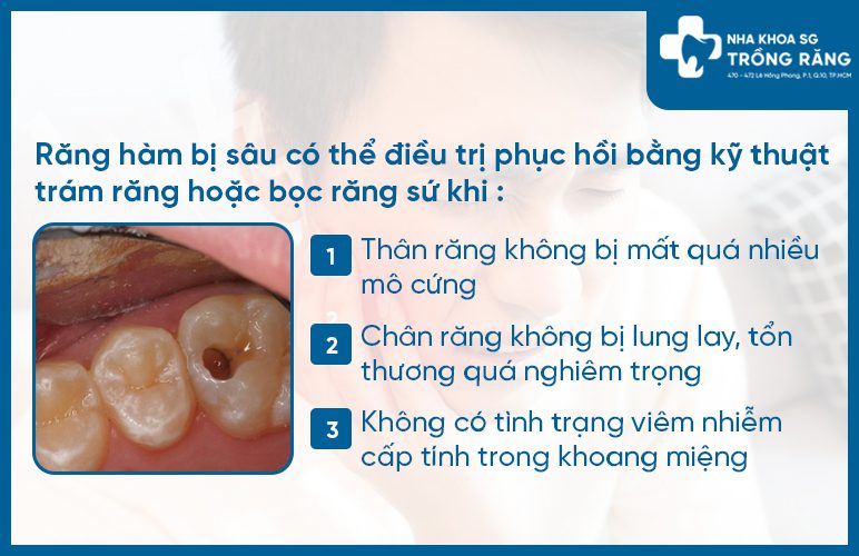 Điều kiện điều trị răng hàm bị sâu