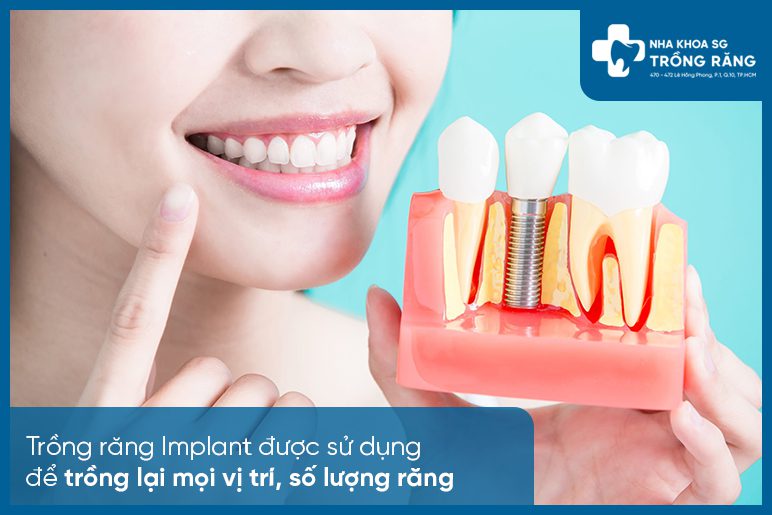 Trồng Implant mọi vị trí số lượng răng