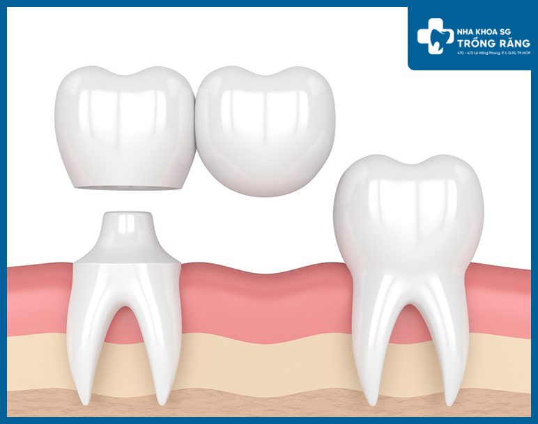 Trong cau rang nhay Trồng cầu răng nhảy