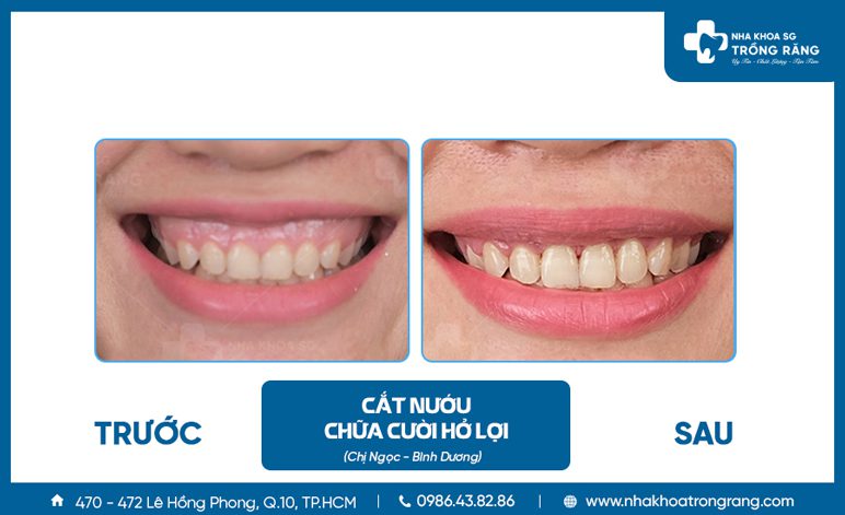 Cách chữa cười hở lợi nhanh nhất & hiệu quả nhất hiện nay