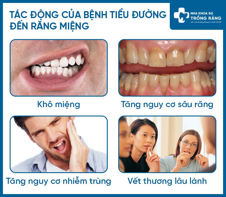 Anh huong cua benh tieu duong den rang mieng Bệnh tiểu đường