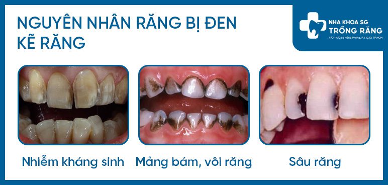 Nguyên nhân kẽ răng bị đen và dấu hiệu sâu răng Nguyên nhân kẽ răng bị đen và dấu hiệu sâu răng