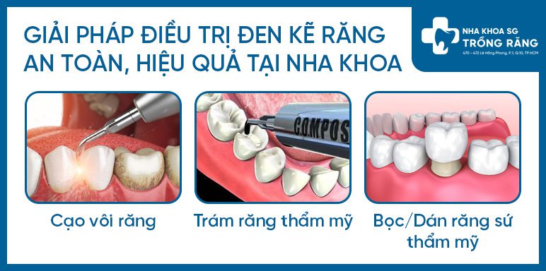 Giải pháp điều trị sâu kẽ răng Giải pháp điều trị sâu kẽ răng