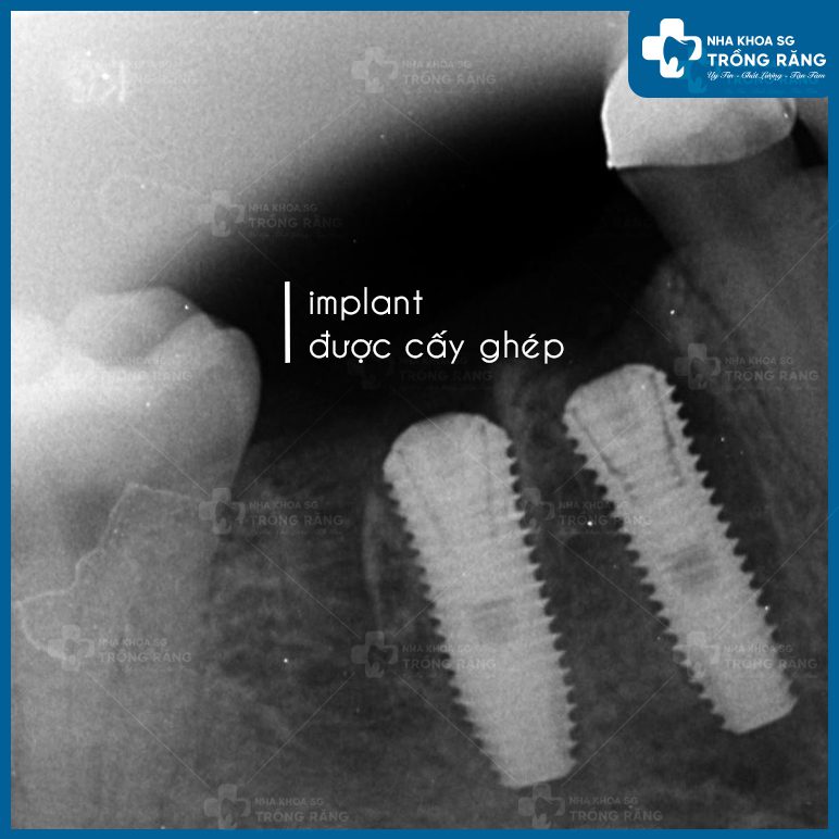 Hình ảnh Implant sau khi được cấy ghép