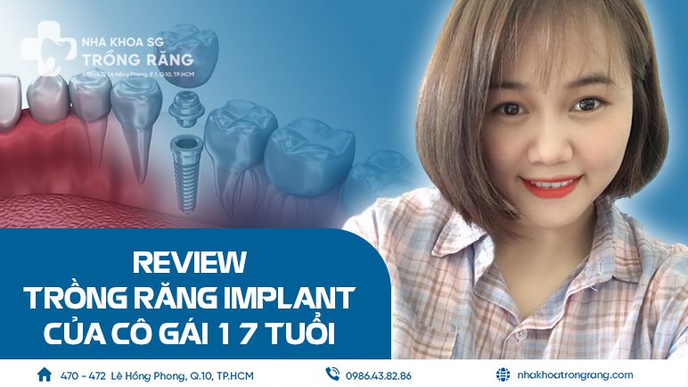 Review trồng răng Implant của cô gái 17 tuổi