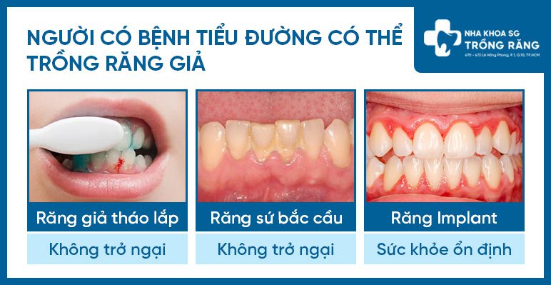 Trong rang gia cho nguoi bi tieu duong Trồng răng giả cho người bị tiểu đường