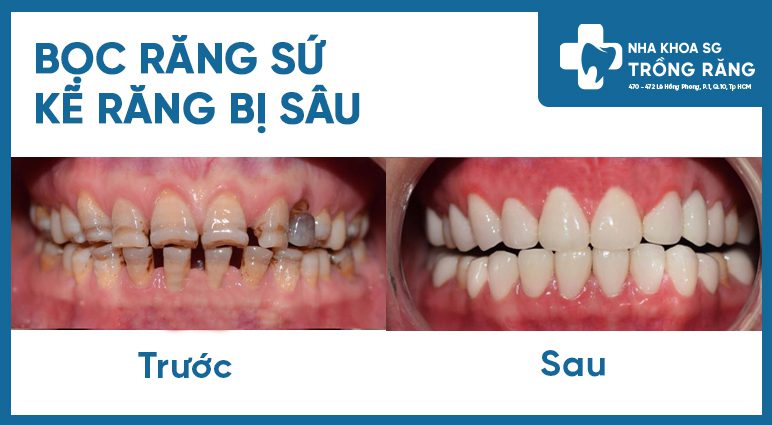 bọc sứ cho răng bị đen kẽ răng bọc sứ cho răng bị đen kẽ răng