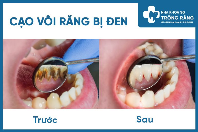 cạo vôi răng trị răng bị đen kẽ răng cạo vôi răng trị răng bị đen kẽ răng