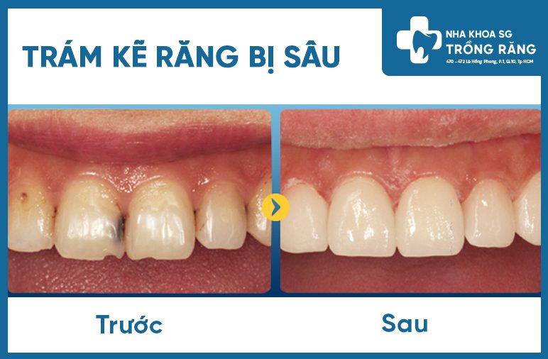 trám răng kẽ bị đen trám răng kẽ bị đen
