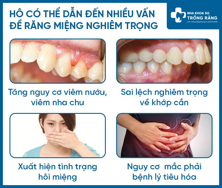 Anh huong cua rang ho Ảnh hưởng của răng hô
