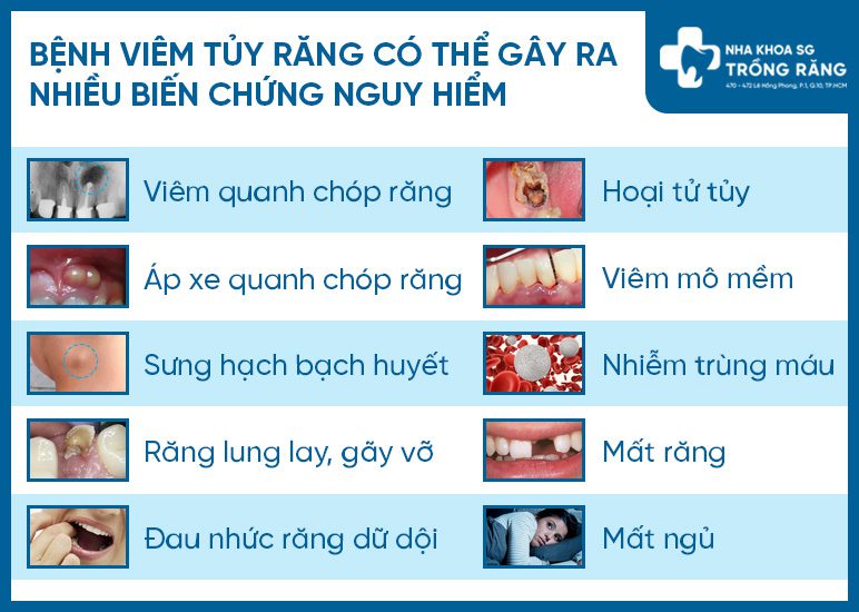 Biến chứng viêm tủy răng Biến chứng viêm tủy răng
