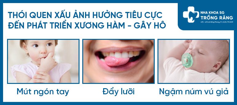 Cac thoi quen xau gay ho rang Các thói quen xấu gây hô răng