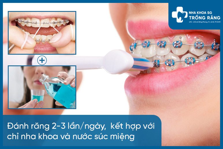 Cham soc rang sau khi nieng Chăm sóc răng sau khi niềng