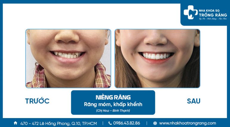 Niềng răng bị lệch khớp cắn - cách xử lý giúp hàm cân đối hài hòa