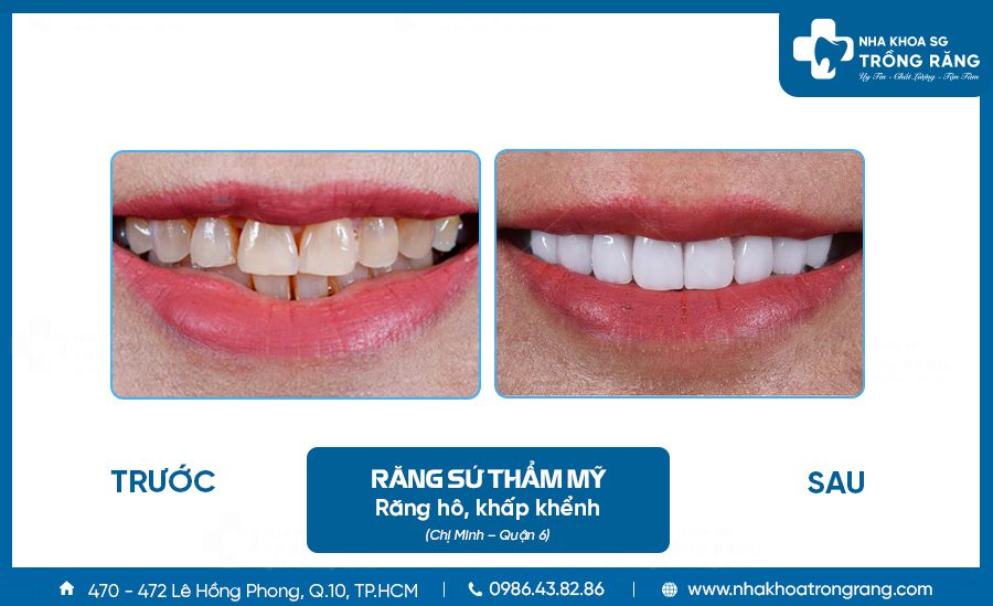 Chua rang ho khong can nieng bang cach boc su Chữa răng hô không cần niềng bằng cách bọc sứ