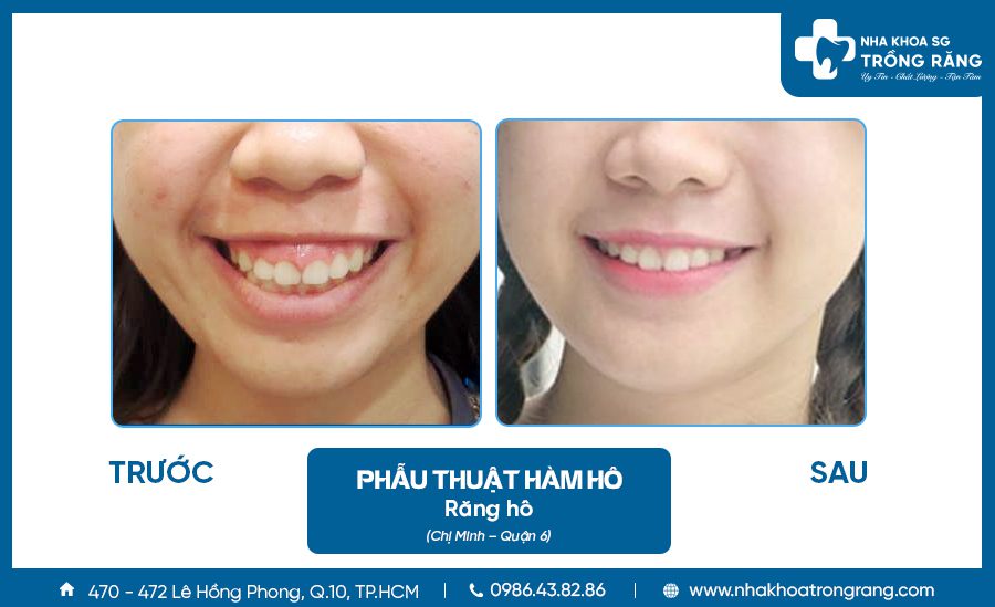 Chua rang ho khong can nieng bang cach phau thuat Chữa răng hô không cần niềng bằng cách phẫu thuật