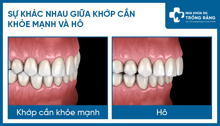 Khop can khoe manh va khop can ho Khớp cắn khỏe mạnh và khớp cắn hô