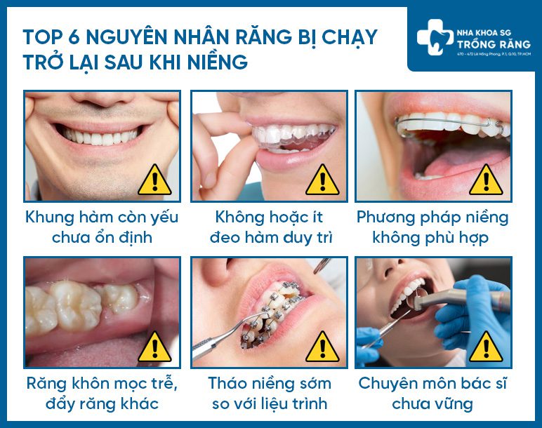 Một số nguyên nhân niềng răng bị chạy lại