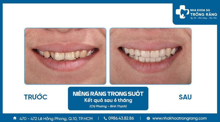 Nieng rang trong suot ket qua sau 6 thang Niềng răng trong suốt kết quả sau 6 tháng