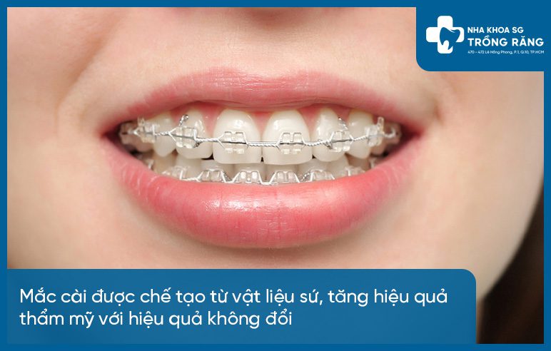 Ưu nhược điểm niềng răng mắc cài sứ