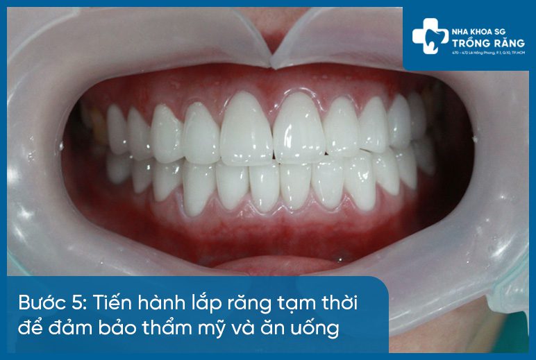 Bước 5 bọc răng sứ