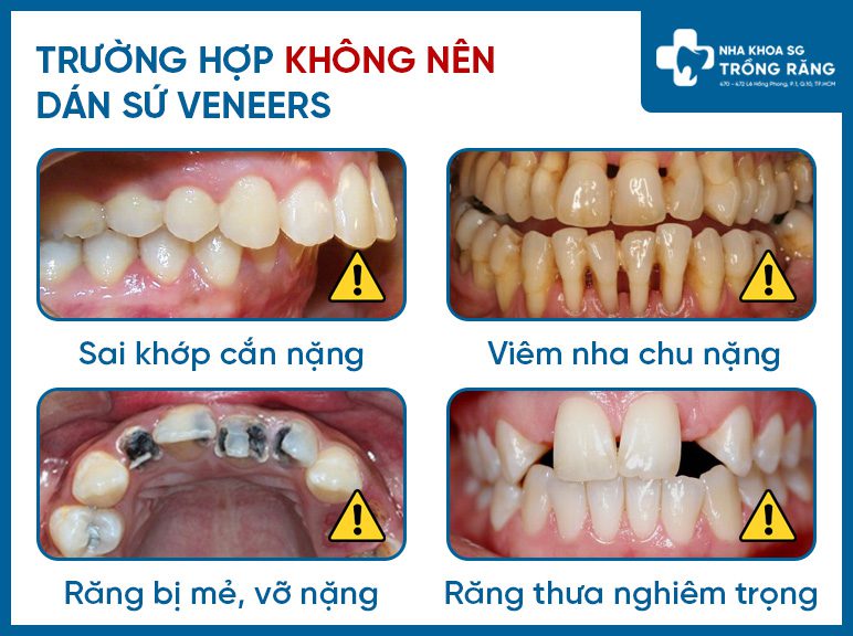 Cac truong hop khong dan su veneer duoc Dán răng sứ veneer - tất tần tật thông tin cần biết
