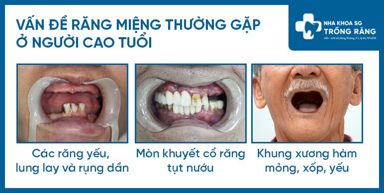 Các vấn đề răng miệng ở người cao tuổi Các vấn đề răng miệng ở người cao tuổi