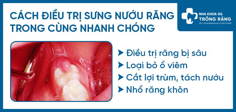 Cách điều trị sưng nướu răng trong cùng