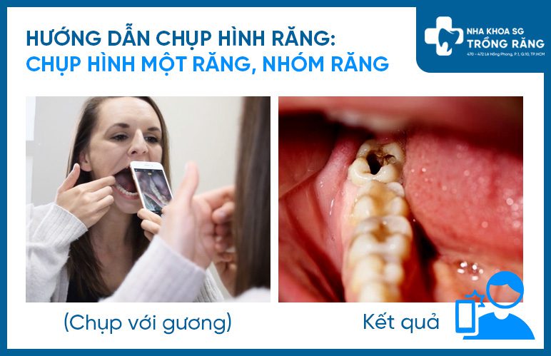 Chụp hình răng cận cảnh Chụp hình răng cận cảnh