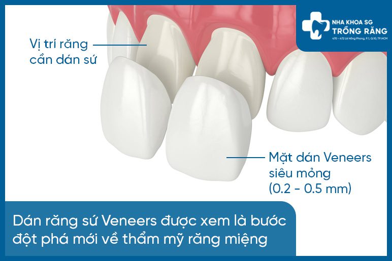 Dan rang su veneer la gi Dán răng sứ veneer - tất tần tật thông tin cần biết