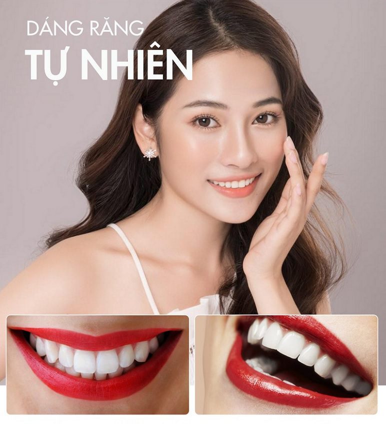 Hình ảnh bọc răng sứ nguyên hàm Hình ảnh trồng răng sứ đẹp