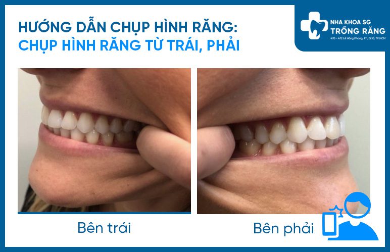 Hướng dẫn chụp hình răng các bên Hướng dẫn chụp hình răng các bên