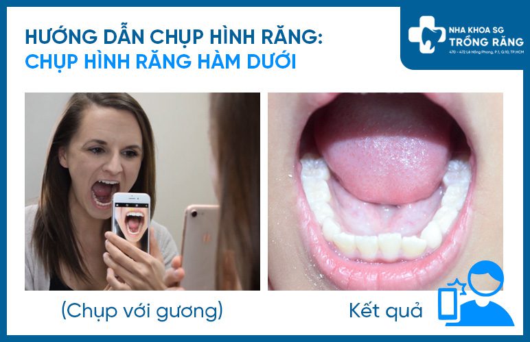 Hướng dẫn chụp hình răng cận cảnh trong miệng hàm dưới Hướng dẫn chụp hình răng cận cảnh trong miệng hàm dưới
