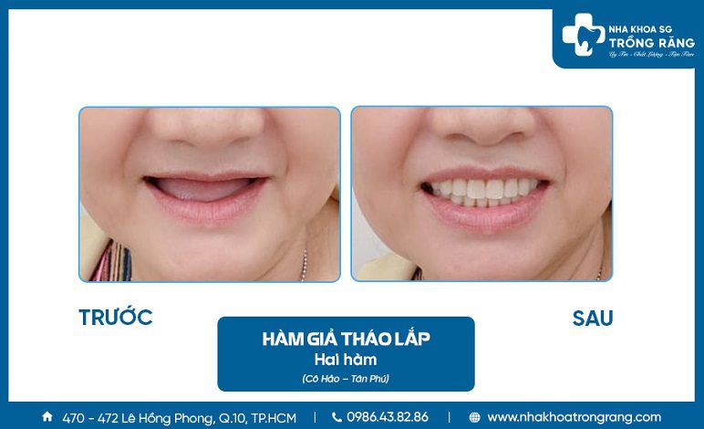 Làm hàm giả tháo lắp nguyên hàm