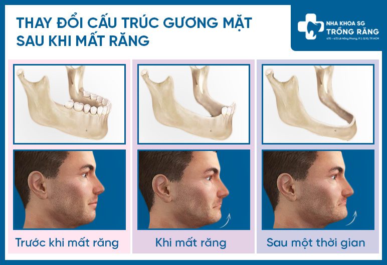 Mất răng khiến thay đổi cấu trúc khuôn mặt Mất răng khiến thay đổi cấu trúc khuôn mặt