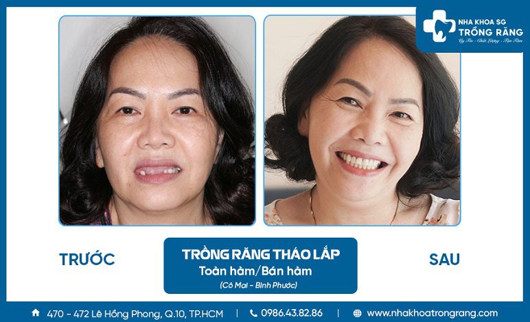 Người cao tuổi trồng răng giả tháo lắp Người cao tuổi trồng răng giả tháo lắp