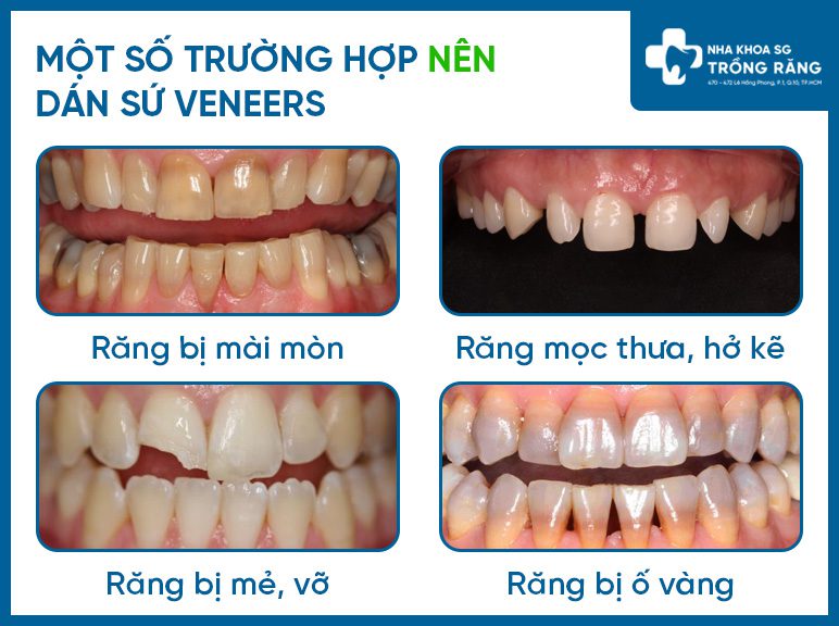 Nhung truong hop nen dan rang su veneer Dán răng sứ veneer - tất tần tật thông tin cần biết