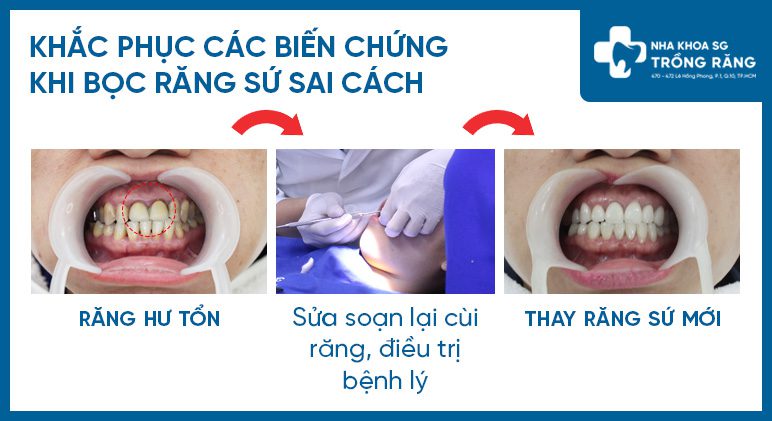 Sửa chữa biến chứng bọc răng sứ sai cách