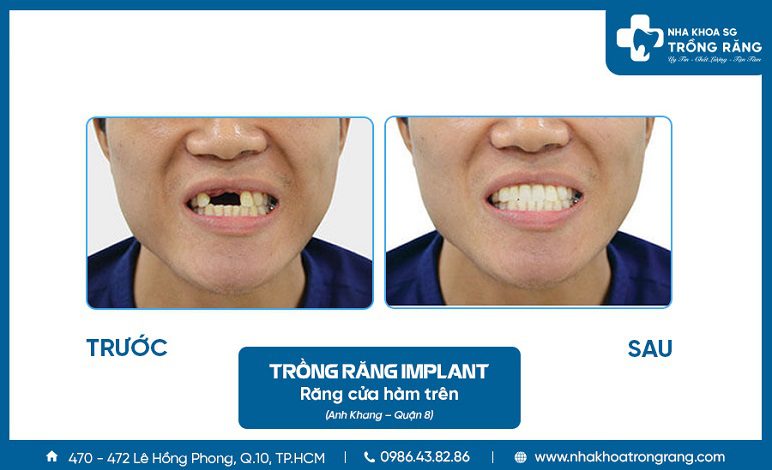 Trồng răng cửa cố định bằng implant