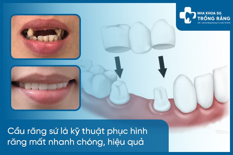 Trong rang su dep bang phuong phap bac cau Trồng răng sứ đẹp bằng phương pháp bắc cầu