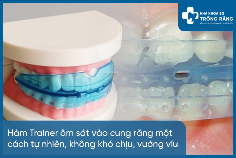 Ưu điểm niềng răng bằng hàm trainer cho bé