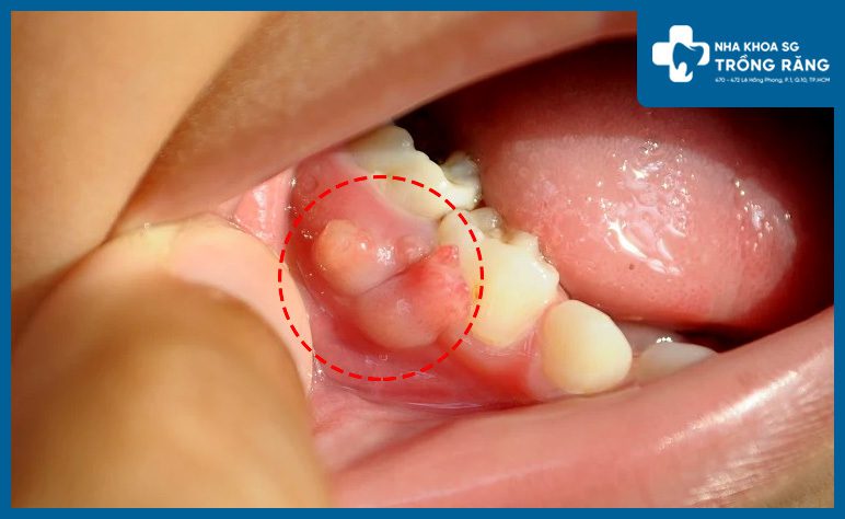 Áp xe răng gây đau nhức răng vào ban đêm