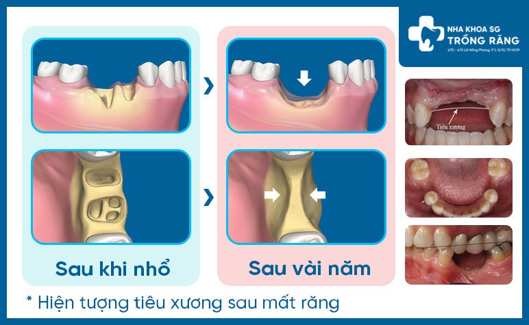 Biểu hiện tiêu xương hàm khi mất răng