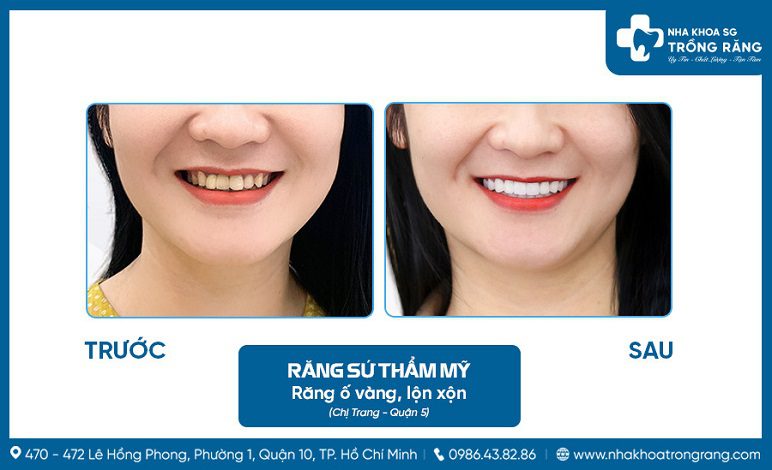 Boc rang su 2 ham co tot khong Bọc răng sứ 2 hàm có tốt không