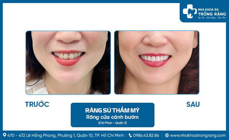 Boc rang su loai nao tot Bọc răng sứ loại nào tốt
