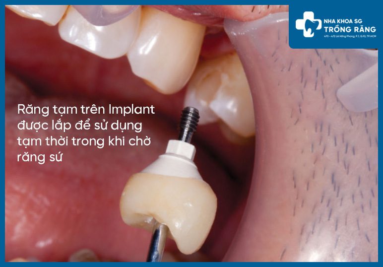 Cach gan rang tam tren implant Cách gắn răng tạm trên implant